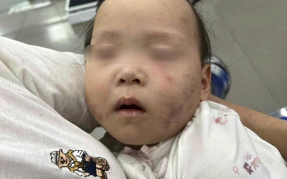 Làm rõ nguyên nhân bé gái bị bầm tím mặt khi gửi ở nhà trẻ Bắc Ninh