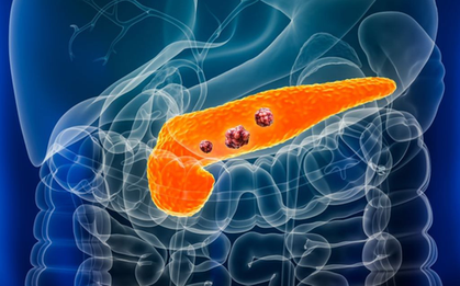 Thói quen khiến hàng triệu người có nguy cơ mắc ung thư tuyến tụy, nhất là nam giới càng làm nhiều