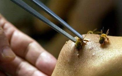 Vụ mẹ tử vong, con 3 tuổi nhập viện do bị ong vò vẽ đốt: Người mẹ lấy thân che chắn cho con, chịu đến 200 vết đốt