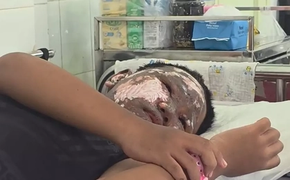 Chơi pháo nổ, bé trai bị tai nạn cháy đen khuôn mặt