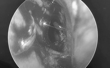 Đi khám, người đàn ông sốc nặng khi bác sĩ thấy thứ "đáng sợ" trong mũi mình