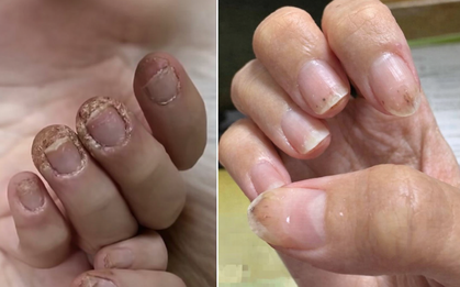 Cô gái 28 tuổi móng tay "mục như gỗ", chạm nhẹ là rụng cả mảng vì sở thích "vạn người mê" của các chị em