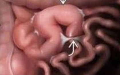 Tắc ruột do dây chằng - biến chứng nguy hiểm sau phẫu thuật ổ bụng không thể chủ quan