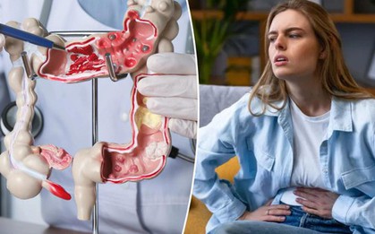 Không phải di truyền, chính những món quen thuộc này có thể đang "nuôi lớn" ung thư đại trực tràng ở phụ nữ trẻ