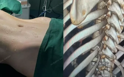 Xu hướng bẻ xương sườn để có vòng eo con kiến