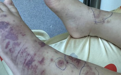 Chuyên gia cảnh báo về một căn bệnh nguy hiểm, lây lan nhanh, tỉ lệ tử vong cao