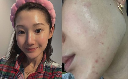 Beauty editor 29 tuổi, da tốt mà vẫn toang vì mụn: Hành trình “cứu” da chỉ với 6 sản phẩm nền tảng