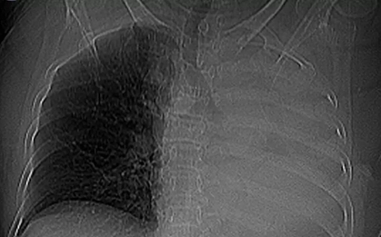 Sặc một viên thuốc, cụ bà xẹp toàn bộ phổi trái