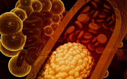 Rối loạn mỡ máu - nguy cơ âm thầm gây nhồi máu cơ tim ở người trẻ