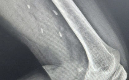 Thói quen nhiều người Việt mê mẩn khiến sán “làm tổ” dưới da mà không hay biết