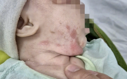 Bệnh lây qua đường tình dục gia tăng, trẻ sơ sinh cũng mắc