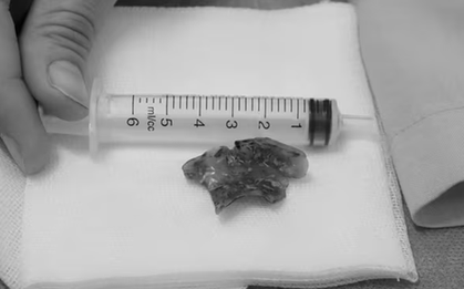 Nửa đêm đau họng, người phụ nữ 55 tuổi phát hiện bí mật "đáng sợ"