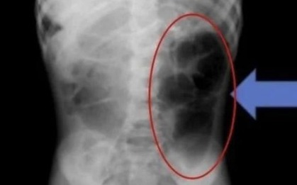 Bé gái đau bụng đi khám, bác sĩ lấy thứ "đáng sợ" bên trong