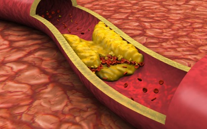 PGS Viện Dinh dưỡng Quốc gia: Đây là thói quen ăn uống khiến mỡ máu cao vút