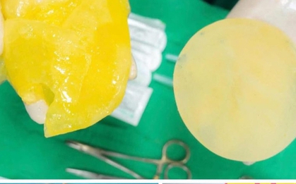 Phụ nữ đã "trùng tu" vòng 1 có nên chơi pickleball?