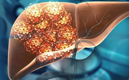 Khối u gan 6 cm đột nhiên biến mất sau khi chuyện này xảy ra