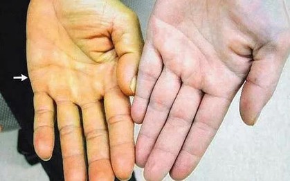 Suy gan cấp vì tự ý dùng thuốc nam không rõ nguồn gốc
