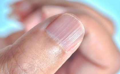 Móng tay nổi sọc dọc, cảnh báo dấu hiệu bất thường vấn đề sức khỏe