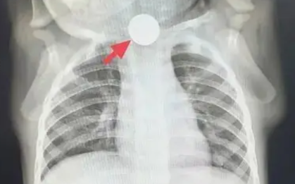 Bé trai 1 tuổi bỏ ăn cả tuần, nguyên nhân được phát hiện khiến bà nội phải thốt lên: "Đúng là lỗi của tôi"