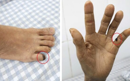 Người phụ nữ 60 tuổi "cứng hàm" suýt mất mạng vì bị gà đá