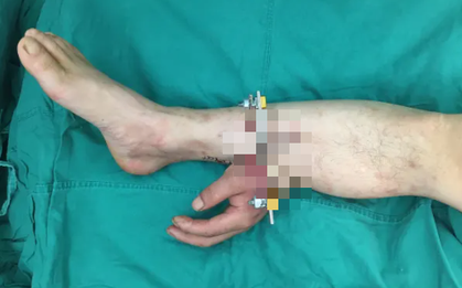 Bác sĩ cứu bàn tay bị đứt lìa của người bệnh bằng cách ghép vào chân