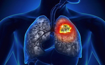 Vì sao ung thư phổi có tỷ lệ tử vong cao?