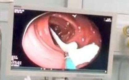 Người đàn ông 35 tuổi sốc nặng khi thấy ký sinh trùng "khổng lồ" đang sống trong ruột