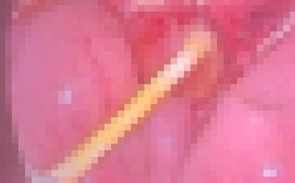 Bé 5 tuổi đau bụng kéo dài, gia đình sốc nặng khi bác sĩ gắp ra thứ "đáng sợ" trong bụng bé