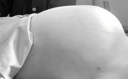 Cảnh báo bướu buồng trứng ở trẻ từ dấu hiệu bụng to nhanh