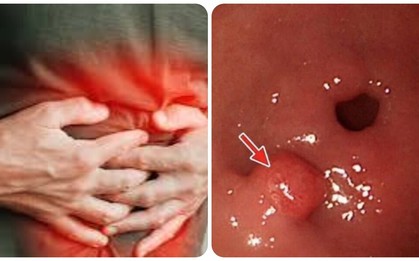 7 dấu hiệu ung thư dạ dày không nên bỏ qua