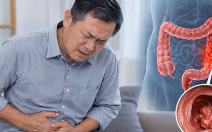 Bác sĩ chỉ: 6 DẤU HIỆU cảnh báo ung thư ruột, nhiều người nhầm tưởng là "rối loạn tiêu hóa"