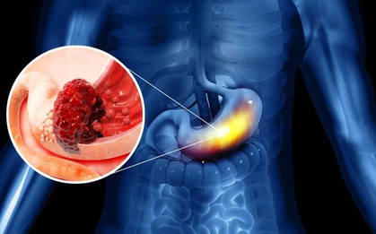 Không chỉ rượu bia, ung thư dạ dày thường "để mắt” tới những người thường xuyên sử dụng loại đồ uống này