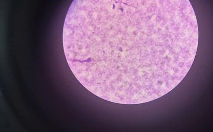 Phát hiện ca bệnh sốt rét ngoại lai, điều trị dài ngày không khỏi
