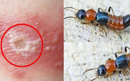 Kiến ba khoang "vào mùa", cẩn trọng dễ nhầm với zona thần kinh