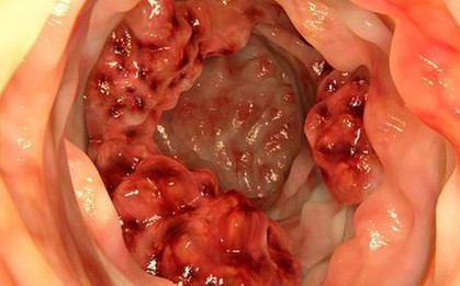 Bác sĩ cảnh báo 5 dấu hiệu ung thư đại trực tràng thường bị bỏ sót
