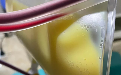 Người phụ nữ 30 tuổi "máu trắng đục như sữa" vì thói quen nhiều người mắc mà không hay