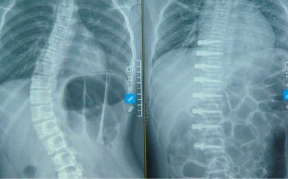 Việt Nam lần đầu tiên phẫu thuật nắn chỉnh vẹo cột sống không ghép xương: Cột sống bé gái thẳng tắp sau ca mổ chưa từng có