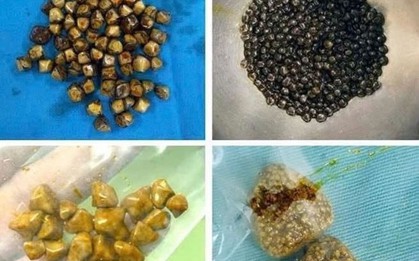 Bác sĩ bất ngờ khi gắp 49 viên sỏi trong túi mật người phụ nữ