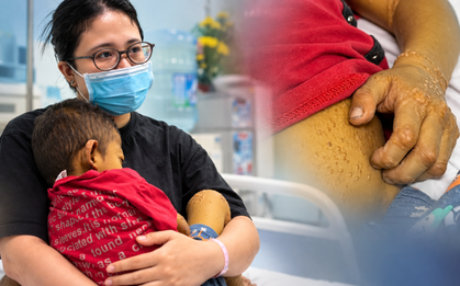 Con 4 tuổi da vàng như nghệ phải thay gan: Mẹ “sốc” khi biết căn bệnh phía sau