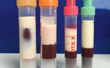 Bé gái 12 tuổi máu "trắng đục như sữa" vì thường xuyên ăn món quen thuộc "vạn người mê"