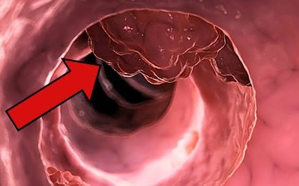Khảo sát 522 người tử vong vì ung thư đại trực tràng phát hiện 3 điểm chung đáng chú ý