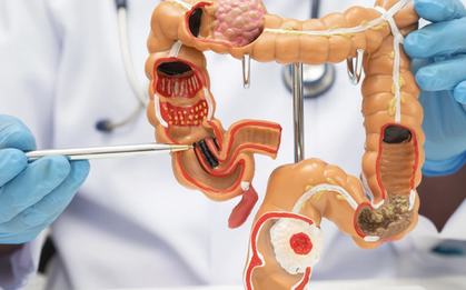 Đau bụng kéo dài, cụ bà 72 tuổi nhập viện trong tình trạng viêm phúc mạc toàn thể