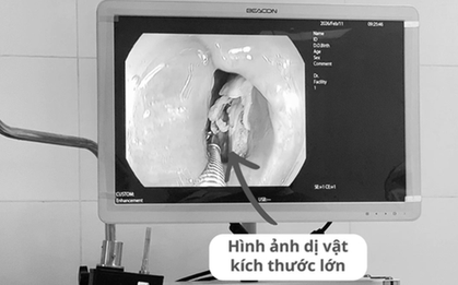 Bệnh nhân 16 tuổi đau họng kéo dài, bác sĩ phát biện bí mật "đáng sợ" bên trong