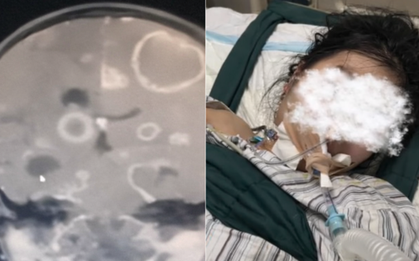 Dọn dẹp nhà đón Tết, bé gái lớp 2 bị "ăn mòn 20 lỗ thủng" ở não