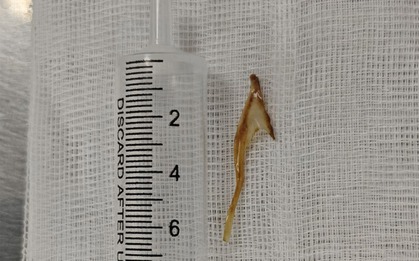 Tưởng bị trĩ hóa ra xương gà dài 3cm mắc ở hậu môn