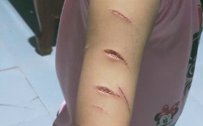 Hé lộ nguyên nhân học sinh lớp 5 bị chị họ dùng dao rạch nhiều nhát lên tay