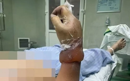 Người phụ nữ có nguy cơ bị cụt cẳng tay khi dựng cây nêu đón Tết