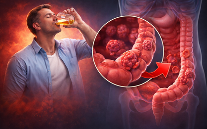 Loại đồ uống làm tăng nguy cơ mắc ung thư đại trực tràng tới 90% nếu sử dụng hằng ngày