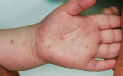 Hà Nội: Ca sốt xuất huyết giảm, bệnh tay chân miệng tăng