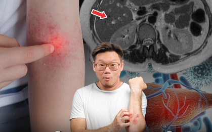 Phó Giám đốc Bệnh viện Thái Lan cảnh báo 4 dấu hiệu trên da là "lời kêu cứu" của gan, nhiều người bỏ qua rồi hối hận không kịp